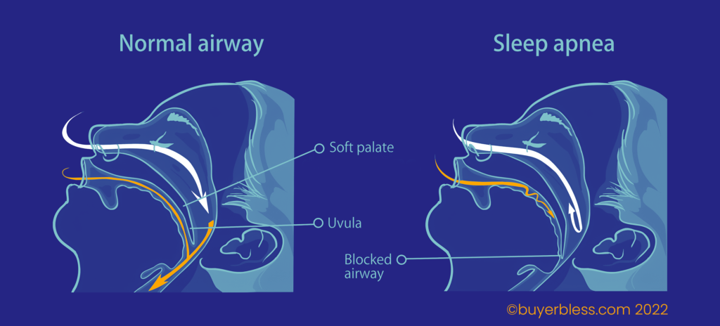 Best Solution for sleep apnea : Causes and treatment in 2022